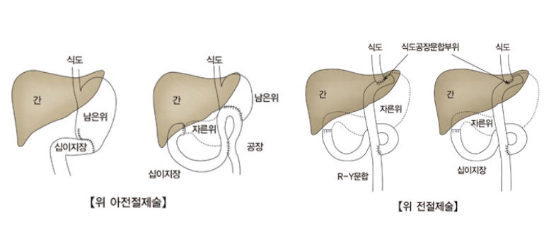 위암 초기증상 및 검사방법, 수술방법 (위암 2기, 3기, 4기 생존율), 위암 4기 복막전이 총정리