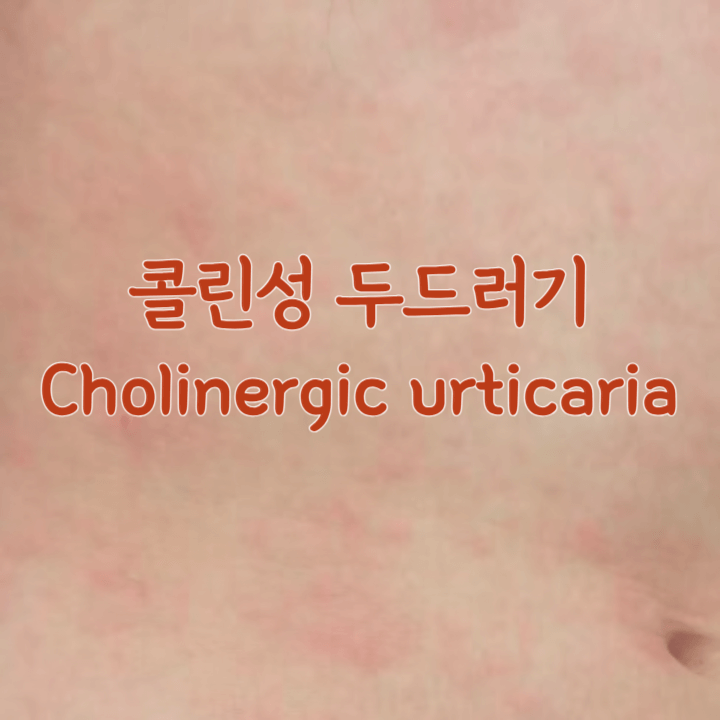 운동하고 샤워만 했을 뿐인데: 콜린성 두드러기 1 콜린성두드러기