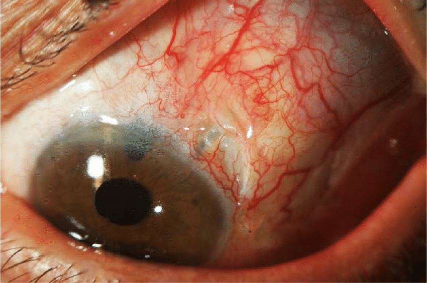 아메드 밸브 삽입술, Ahmed valve implantation 치료과정 수술방법 합병증 부작용