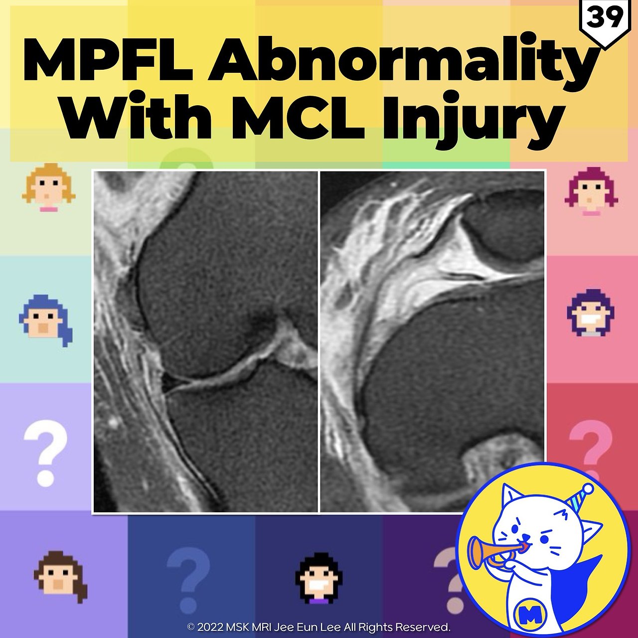 (Fig 4-A.39) Medial Patellofemoral Ligament Abnormality with MCL Injury