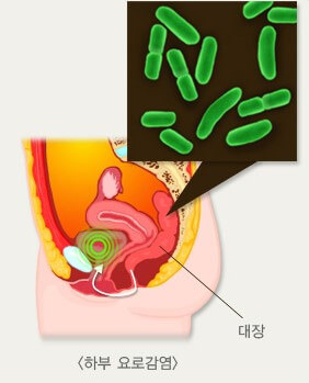 감염 부위와 단순성 여부에 따른 요로감염에 대해 2 하부요로감염