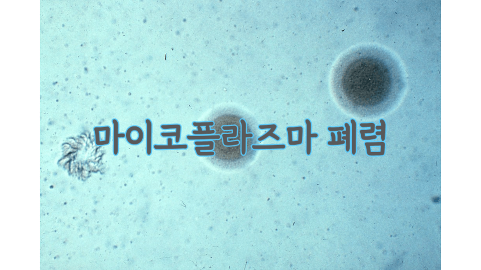 마이코플라즈마 폐렴: 항생제 내성이 있고 심하면 뇌염까지? 1 mycoplasma-pneumonia