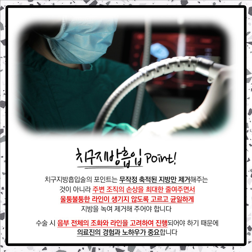 지방흡입 아랫배? 하체? 운동으로도 빠지지 않는 치구 때문 (feat. 치구지방흡입)