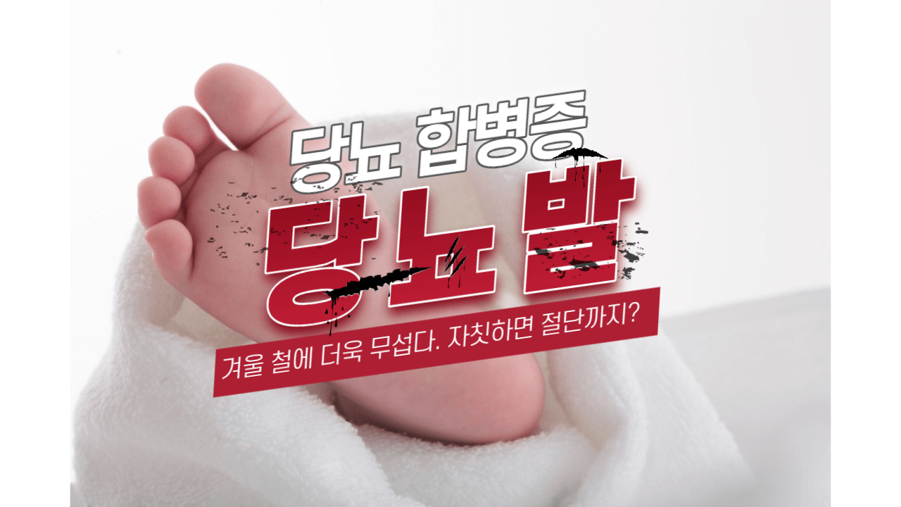 겨울 철 당뇨 합병증 관리 : 절단을 부르는 당뇨 발이란 무엇인가? 1 ywAAAAAAQABAAACAUwAOw==