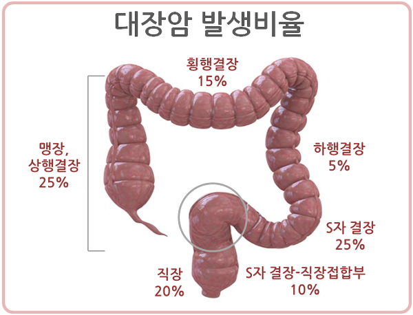 대장암 원인과 초기증상과 생존률 설사 혈변 방귀냄새