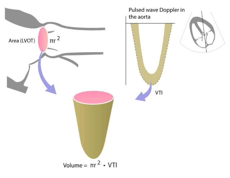 [심초음파 01] 혈역학적 평가 (4) 혈류량의 측정 Qp/Qs ratio