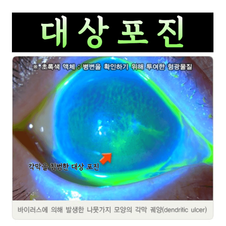 대상포진: 원인부터 치료까지 완벽 가이드 1 ywAAAAAAQABAAACAUwAOw==