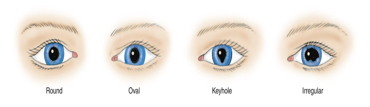 pupil-size-light-reflex