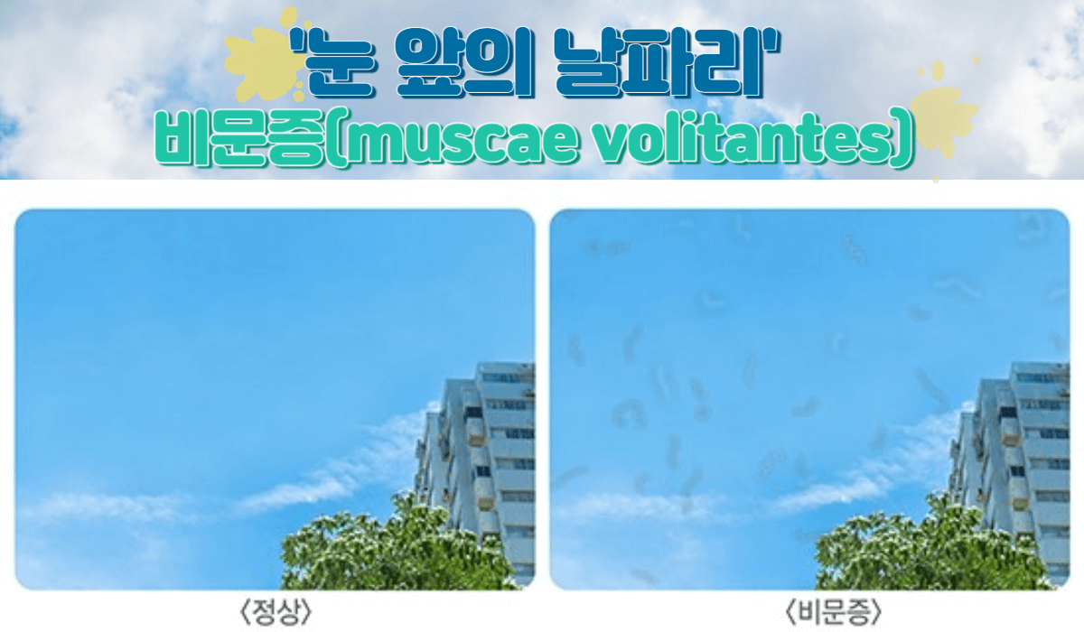 눈 앞에 날파리가? : 비문증(muscae volitantes) 1 비문증