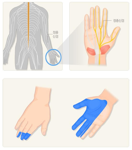 찌릿찌릿 저린 손목: 손목 터널 증후군(carpal tunnel syndrome) 2 정중신경의 지배영역