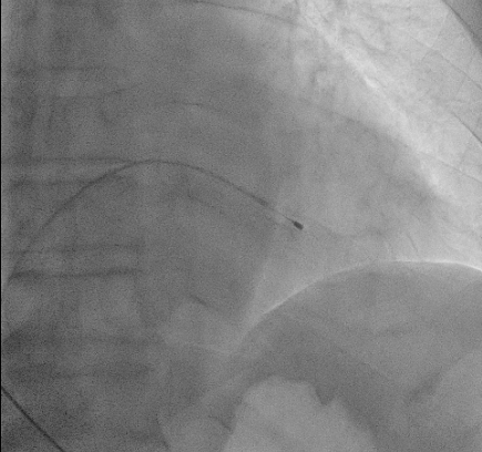 일시적 심박동기(Temporary pacemaker)