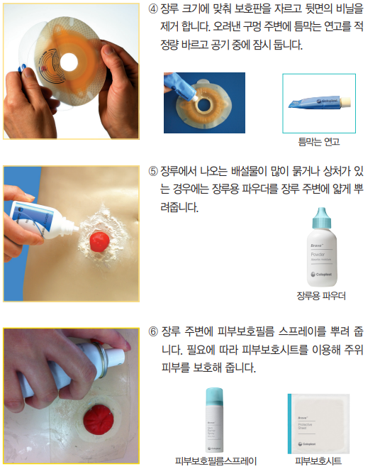 장루란?,장루종류와형태.장루교체방법.장루합병증
