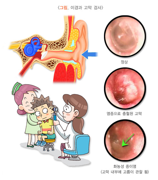 아기 중이염 증상 원인 항생제 예방