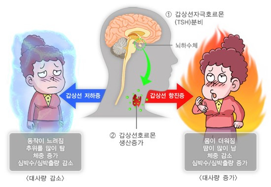 갑상선염의 종류와 증상 1 2 갑상선염의 증상