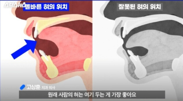 뮤잉운동(mewing) 효과 있나? 뮤잉 운동 시 주의사항