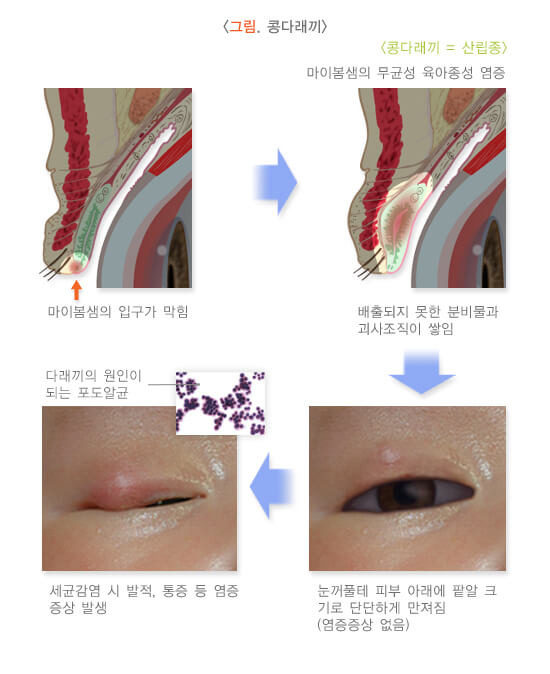 눈꺼풀 분비샘의 염증성 질환: 다래끼와 콩다래끼 3 ywAAAAAAQABAAACAUwAOw==