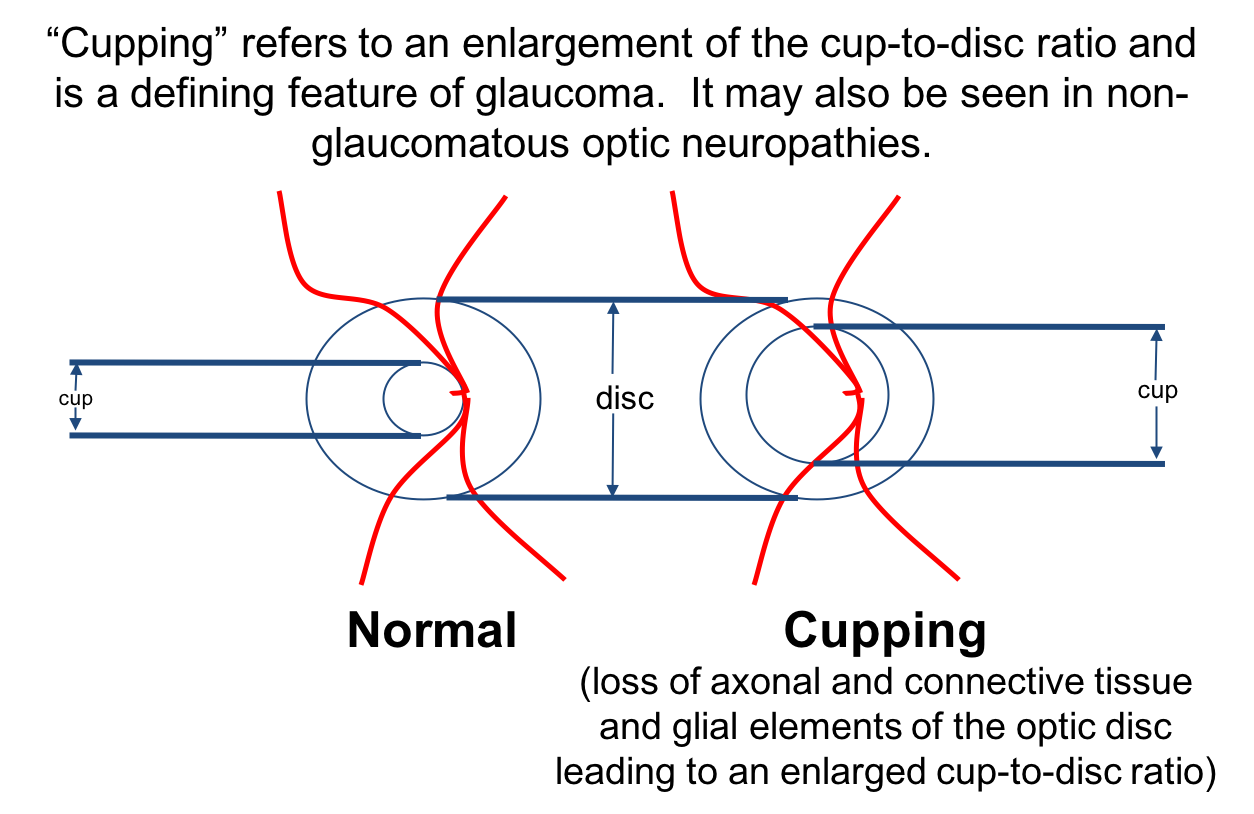 녹내장의 정의 진단 치료 주의해야할 약물