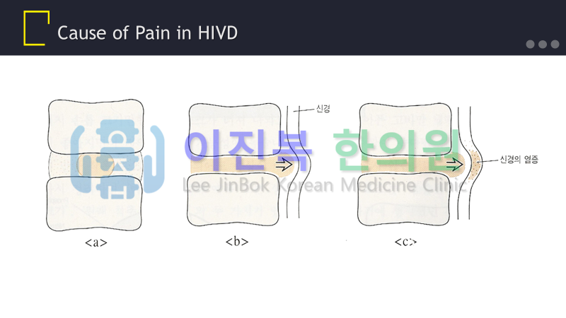 전주 이진복한의원 경추 추간판탈출증(경추 디스크)