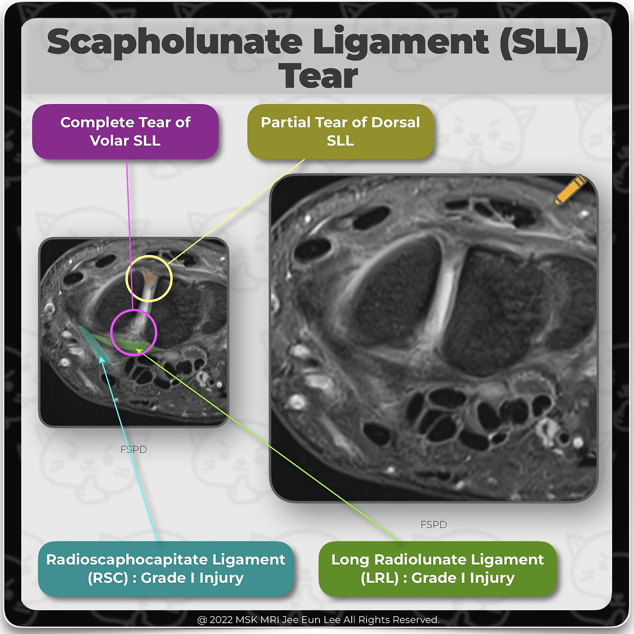 anatomy-08-scapholunate-ligament-tear-radioscaphocapitate-ligament