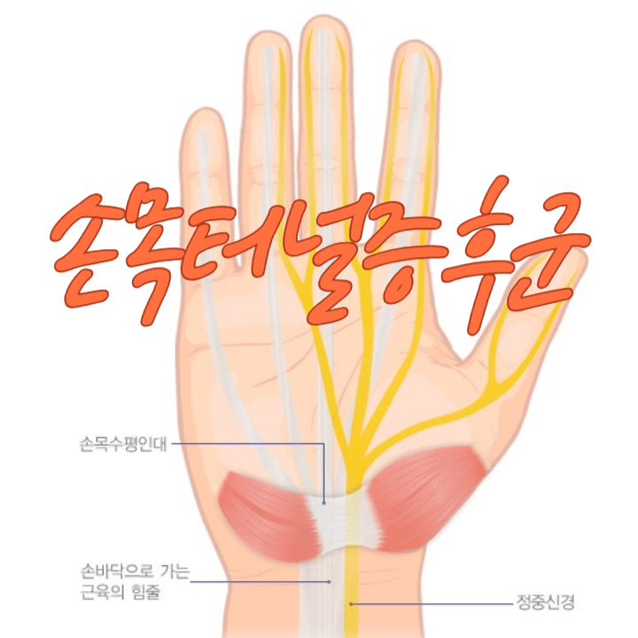찌릿찌릿 저린 손목: 손목 터널 증후군(carpal tunnel syndrome) 1 carpal tunnel syndrome