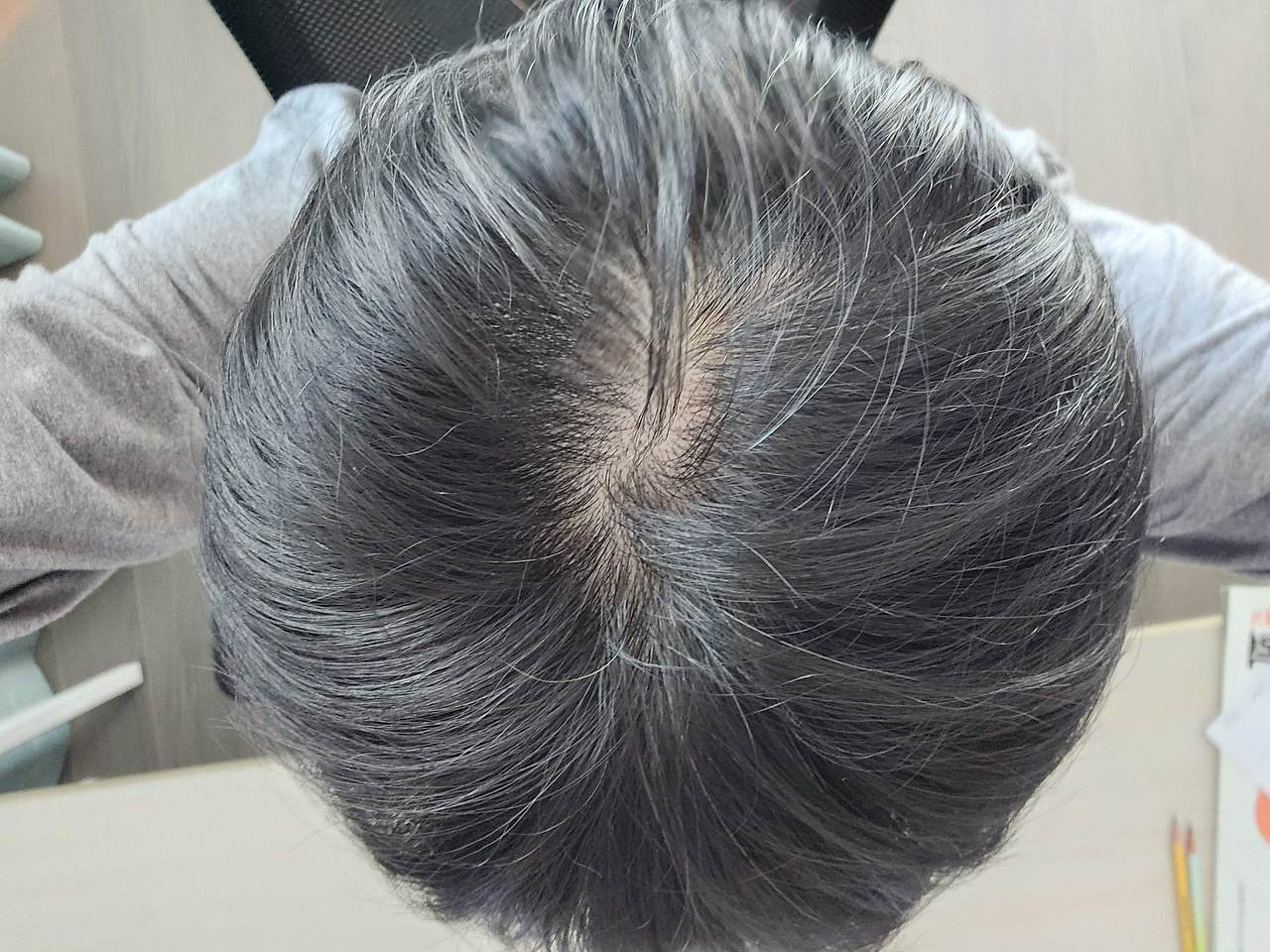 커클랜드 미녹시딜 5% 남자 탈모 쉐딩 3개월 후기 사용팁 (ft. 물파스공병, 마이모닉 가격) 11 ywAAAAAAQABAAACAUwAOw==