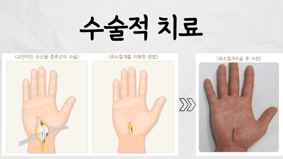찌릿찌릿 저린 손목: 손목 터널 증후군(carpal tunnel syndrome) 5 손목터널증후군-수술적치료