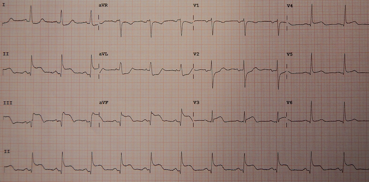 Territory에 따른 STEMI 심전도 차이. STEMI culprit.