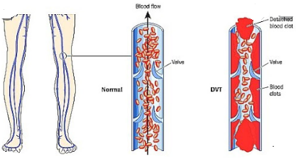 심부정맥 혈전증(DVT)