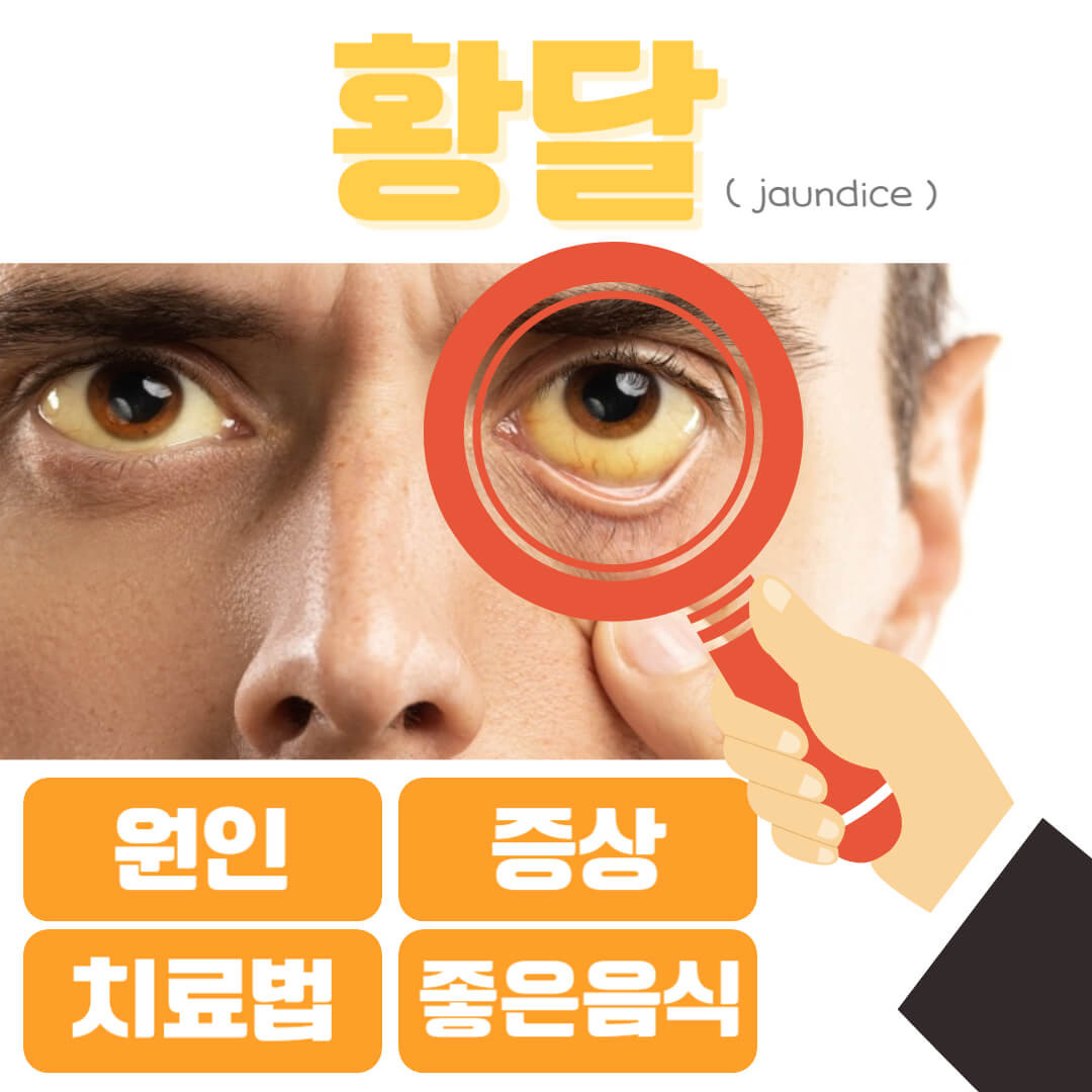 황달 원인 / 증상 / 치료법 / 좋은음식