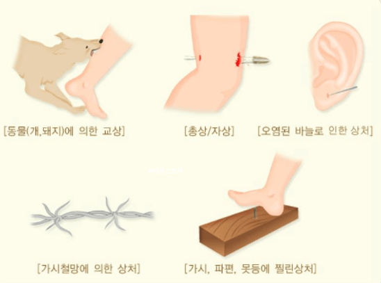 파상풍 초기 증상 예방방법 및 감염원인