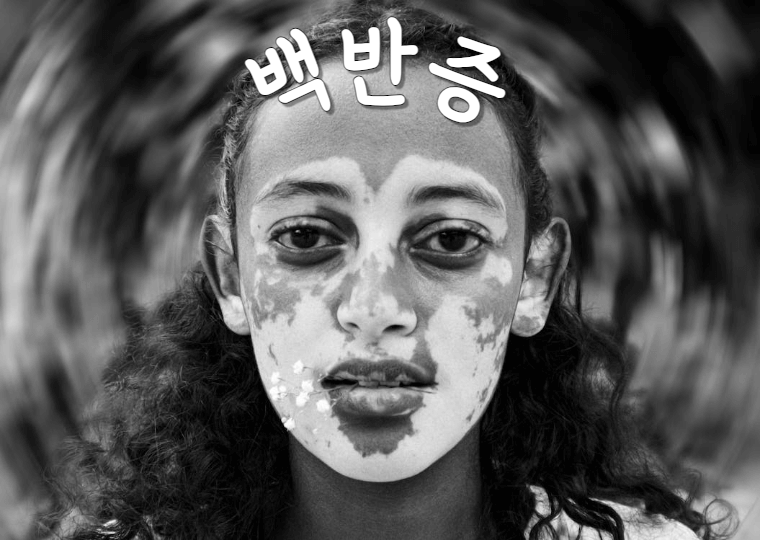 피부에 생기는 흰 반점: 백반증(Vitiligo) 1 ywAAAAAAQABAAACAUwAOw==