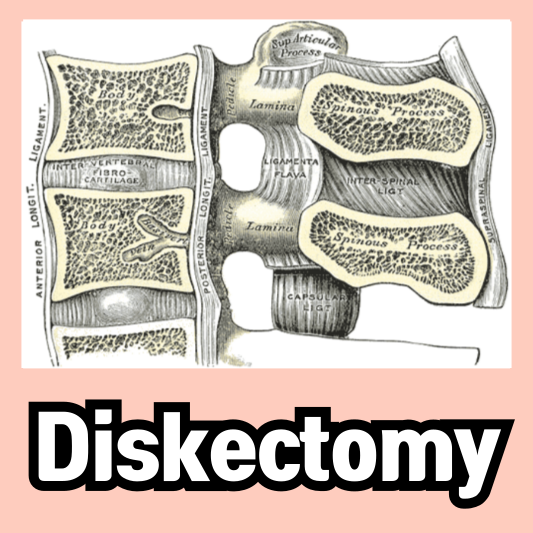 lumbar diskectomy disectomy procedure