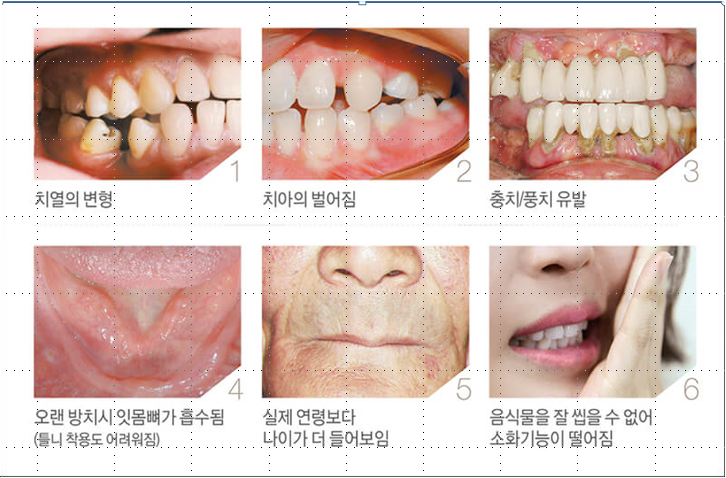 임플란트 시술 6종류 내게 맞는 방법은?