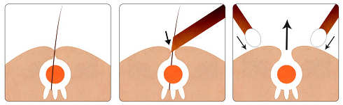 (꿀팁)좁쌀 여드름 없애는 방법과 피부 관리