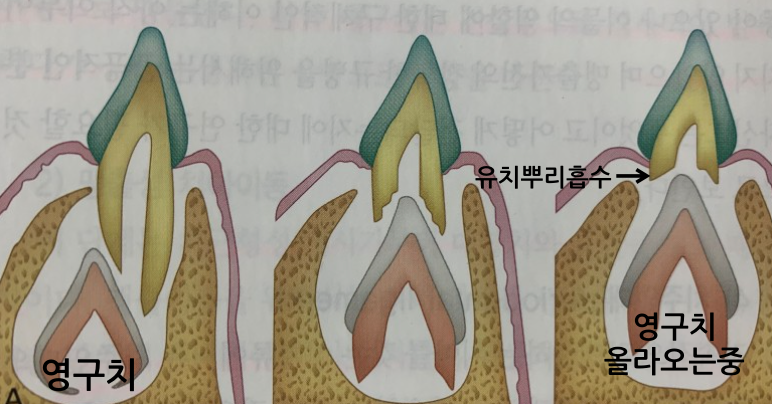 유치 집에서 빼도 될까요? 아이치아빼기, 유치 발치 주의사항