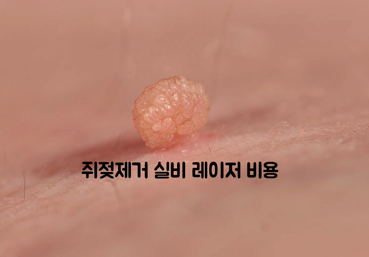 쥐젖제거 실비 레이저 비용