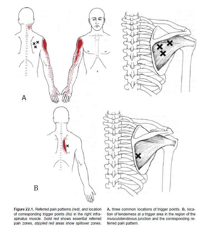 Подостная мышца триггерные точки. Триггерные точки при плечелопаточном периартрите. Триггерные точки плечевого сустава. Подостная мышца плеча триггерные точки.