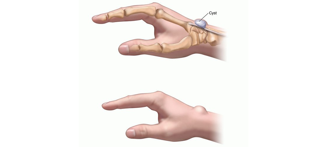 Гигрома лучезапястного сустава кисти. Ганглий лучезапястного сустава. Сухожильный ганглий лучезапястного сустава.
