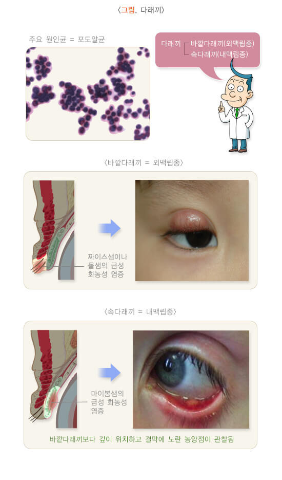 눈꺼풀 분비샘의 염증성 질환: 다래끼와 콩다래끼 2 ywAAAAAAQABAAACAUwAOw==
