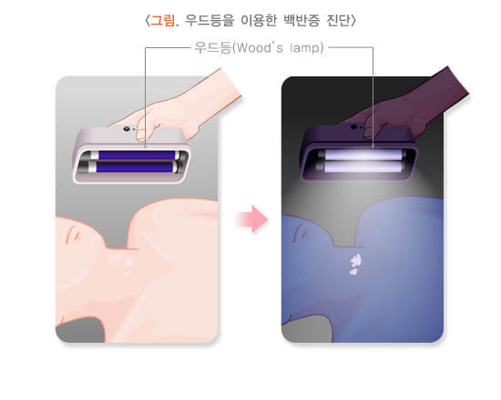 피부에 생기는 흰 반점: 백반증(Vitiligo) 3 ywAAAAAAQABAAACAUwAOw==
