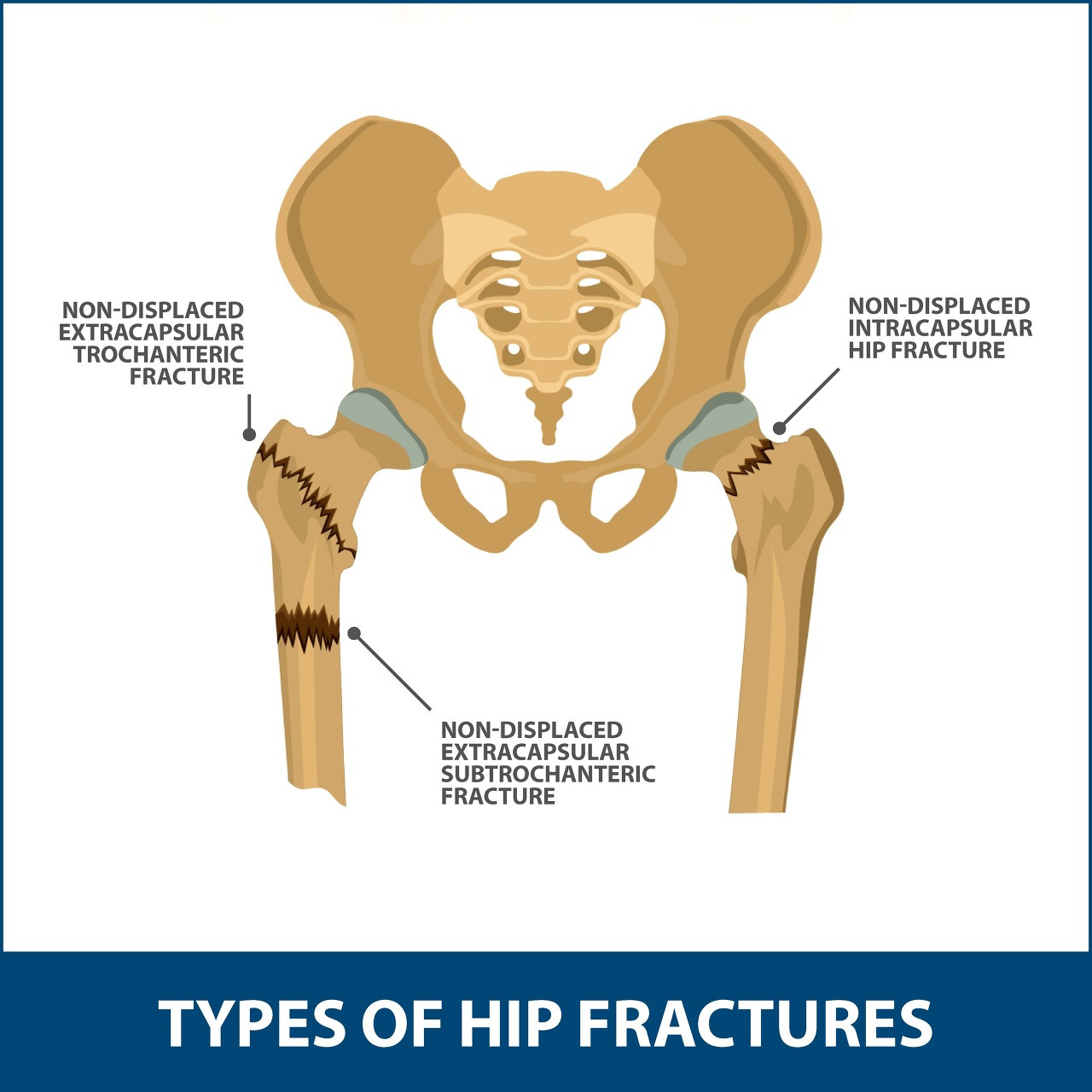 fracures-of-the-hip