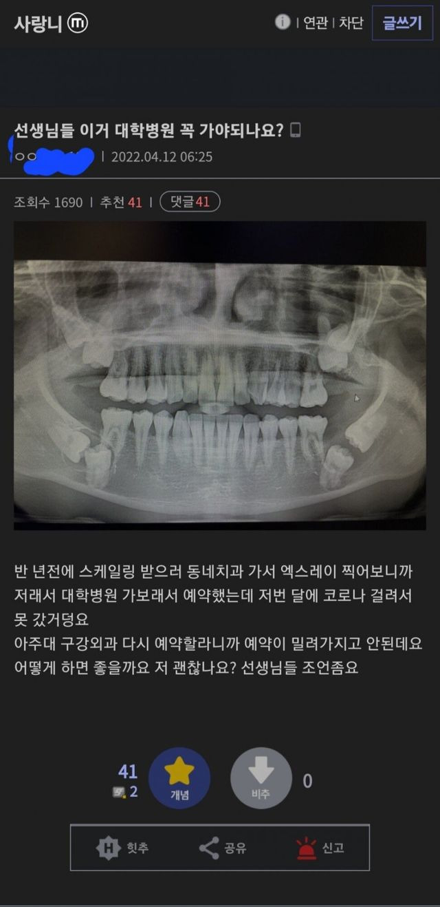 매복사랑니 레전드 그리고 병원 후기