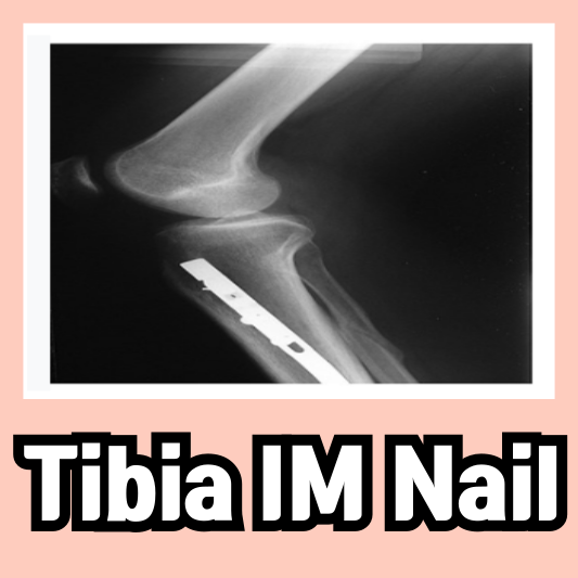 Tibia Fx 수술 Tibia Im Nail 수술 알아보기