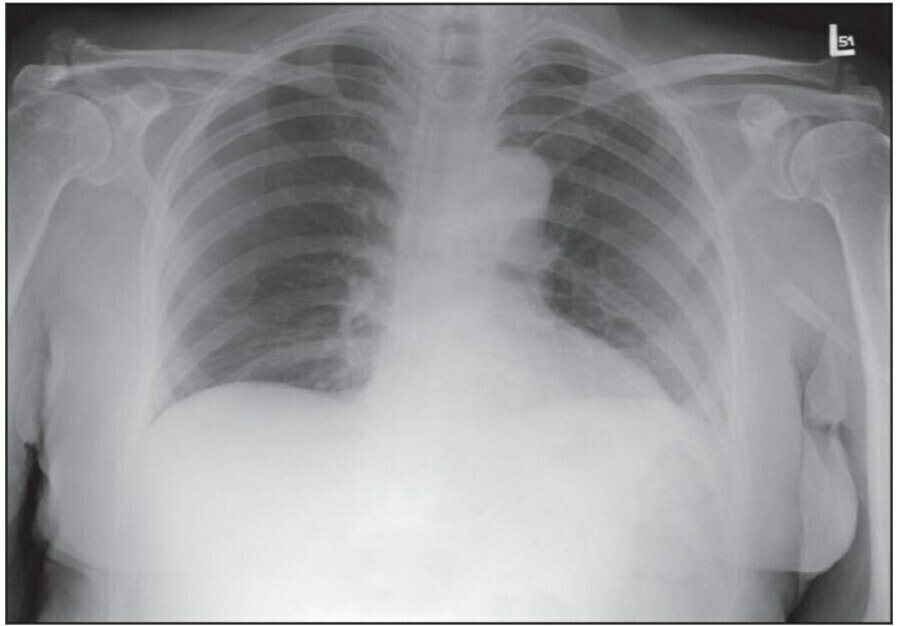 중환자에서 chest X ray 촬영 시 고려할 사항