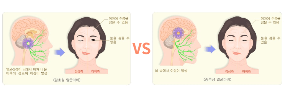 자고 일어났을 뿐인데 얼굴에 마비가? 말초성 안면 마비 VS 중추성 안면 마비 2 안면마비 비교