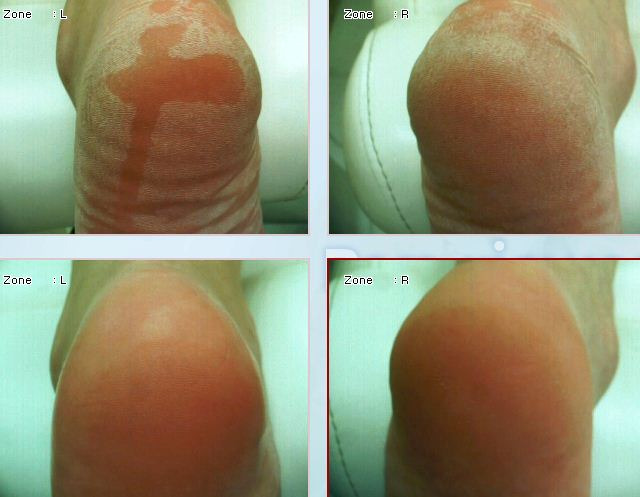 안전하고 통증없는 발뒤꿈치 각질제거 굳은살제거 독일프리미어풋케어솔루션 뒤꿈치각질전문 분당푸스올 - 분당 푸스올