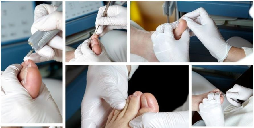 내성발톱전문 통증이 없는 내성발톱 교정케어 분당푸스올 문제성발관리