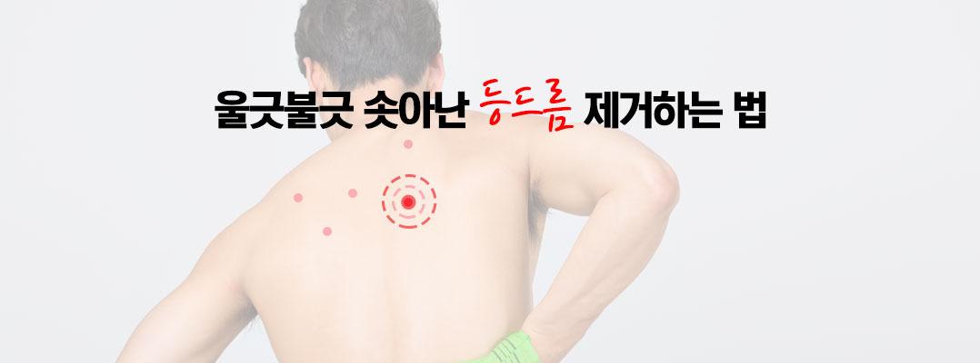 지긋지긋한 등 근육을 빼는 방법은? (등 여드름, 가슴 여드름, 등 여드름 치료)