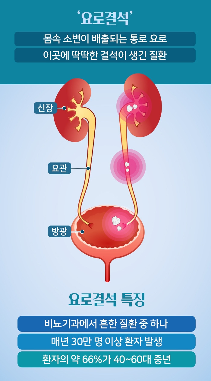 환자 2명 중 1명 재발하는 ‘요로결석’