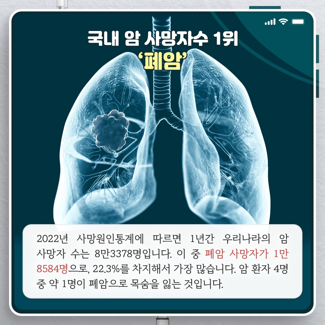 폐암 방사선 치료 후 생긴 ‘섬유 조직’